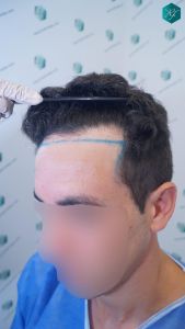 Injerto Capilar Técnica FUE 1873 Grafts (4766 Pelos) 5 6 DISEÑO LINEA INJERTO