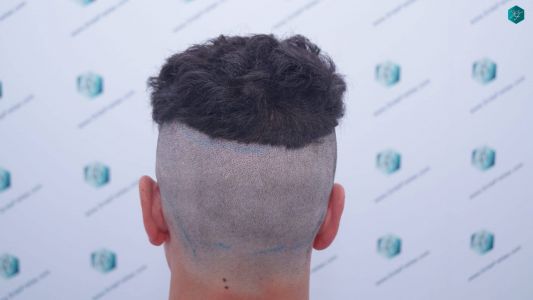 Injerto Capilar Técnica FUE 1873 Grafts (4766 Pelos) 6 7 DISEÑO LINEA INJERTO