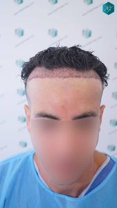 TRASPLANTE INJERTO CAPILAR 8 TRASPLANTE INJERTO CAPILAR