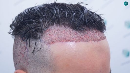 Injerto Capilar Técnica FUE 1873 Grafts (4766 Pelos) 7 9 TRASPLANTE INJERTO CAPILAR