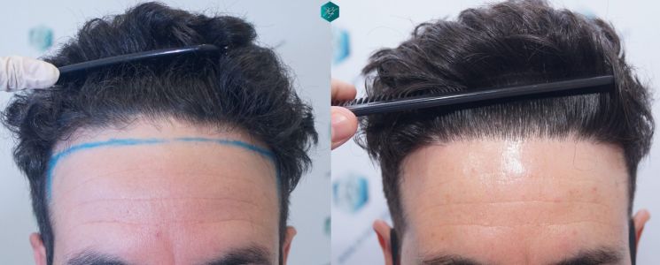 COMPARATIVA INJERTO CAPILAR ANTES Y DESPUES X INJERTO CAPILAR COMPARATIVA ANTES Y DESPUES 1