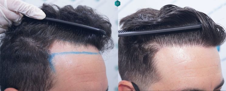 Injerto Capilar Técnica FUE 1873 Grafts (4766 Pelos) 37 X INJERTO CAPILAR COMPARATIVA ANTES Y DESPUES 2