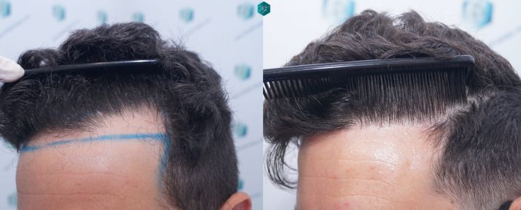 Injerto Capilar Técnica FUE 1873 Grafts (4766 Pelos) 38 X INJERTO CAPILAR COMPARATIVA ANTES Y DESPUES 3