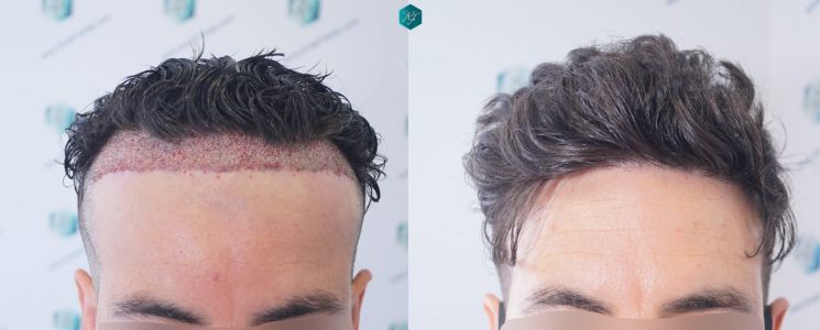 Injerto Capilar Técnica FUE 1873 Grafts (4766 Pelos) 39 X INJERTO CAPILAR COMPARATIVA ANTES Y DESPUES 4