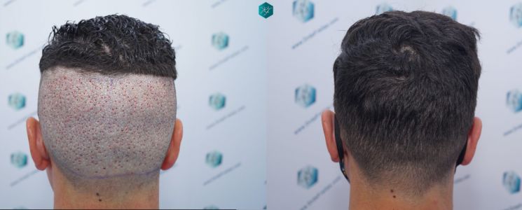 Injerto Capilar Técnica FUE 1873 Grafts (4766 Pelos) 40 X INJERTO CAPILAR COMPARATIVA ANTES Y DESPUES 5