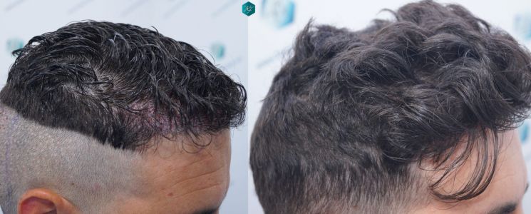 Injerto Capilar Técnica FUE 1873 Grafts (4766 Pelos) 41 X INJERTO CAPILAR COMPARATIVA ANTES Y DESPUES 6