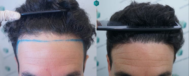 Injerto Capilar Técnica FUE 1873 Grafts (4766 Pelos) 42 X INJERTO CAPILAR COMPARATIVA ANTES Y DESPUES 7