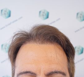 ANTES DE LA REPARACION REPARACIÓN TRASPLANTE CAPILAR