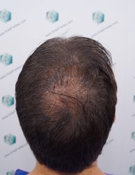 Injerto Capilar Técnica FUE Grafts 2365 (5983 Pelos) - REPARACIÓN 7 DISEÑO LINEA INJERTO CAPILAR