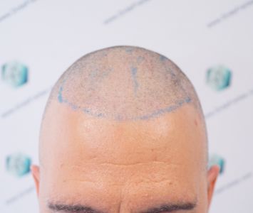 Injerto Capilar Técnica FUE Grafts 2365 (5983 Pelos) - REPARACIÓN 8 DISEÑO LINEA INJERTO CAPILAR