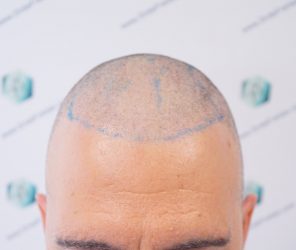 Injerto Capilar Técnica FUE Grafts 2365 (5983 Pelos) - REPARACIÓN 8 DISEÑO LINEA INJERTO CAPILAR