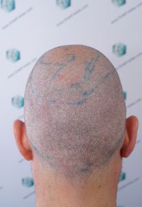 Injerto Capilar Técnica FUE Grafts 2365 (5983 Pelos) - REPARACIÓN 9 DISEÑO LINEA INJERTO CAPILAR