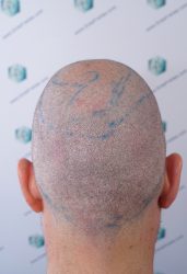 Injerto Capilar Técnica FUE Grafts 2365 (5983 Pelos) - REPARACIÓN 9 DISEÑO LINEA INJERTO CAPILAR