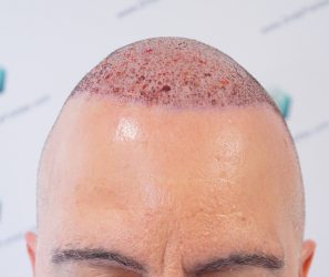 TRASPLANTE INJERTO CAPILAR TRASPLANTE INJERTO CAPILAR