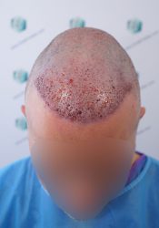 Injerto Capilar Técnica FUE Grafts 2365 (5983 Pelos) - REPARACIÓN 10 TRASPLANTE INJERTO CAPILAR