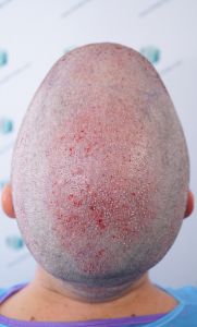 Injerto Capilar Técnica FUE Grafts 2365 (5983 Pelos) - REPARACIÓN 11 TRASPLANTE INJERTO CAPILAR