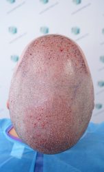 Injerto Capilar Técnica FUE Grafts 2365 (5983 Pelos) - REPARACIÓN 12 TRASPLANTE INJERTO CAPILAR