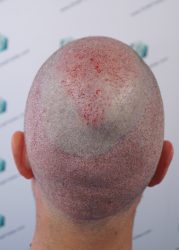 Injerto Capilar Técnica FUE Grafts 2365 (5983 Pelos) - REPARACIÓN 13 TRASPLANTE INJERTO CAPILAR