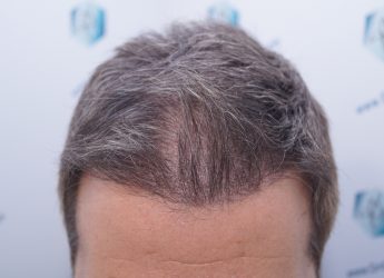 RESULTADOS INJERTO CAPILAR EN 3 MESES RESULTADOS INJERTO CAPILAR EN 3 MESES