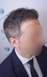 Injerto Capilar Técnica FUE Grafts 2365 (5983 Pelos) - REPARACIÓN 14 RESULTADOS INJERTO CAPILAR EN 3 MESES