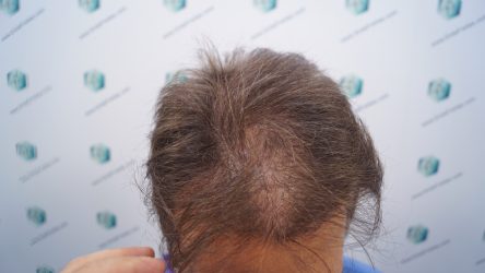 Injerto Capilar Técnica FUE Grafts 2365 (5983 Pelos) - REPARACIÓN 1 ANTES DE UN TRASPLANTE CAPILAR