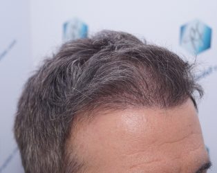 Injerto Capilar Técnica FUE Grafts 2365 (5983 Pelos) - REPARACIÓN 15 RESULTADOS INJERTO CAPILAR EN 3 MESES