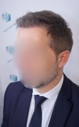 Injerto Capilar Técnica FUE Grafts 2365 (5983 Pelos) - REPARACIÓN 16 RESULTADOS INJERTO CAPILAR EN 3 MESES