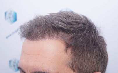 Injerto Capilar Técnica FUE Grafts 2365 (5983 Pelos) - REPARACIÓN 17 RESULTADOS INJERTO CAPILAR EN 3 MESES