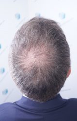 Injerto Capilar Técnica FUE Grafts 2365 (5983 Pelos) - REPARACIÓN 18 RESULTADOS INJERTO CAPILAR EN 3 MESES