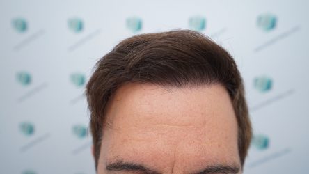 Injerto Capilar Técnica FUE Grafts 2365 (5983 Pelos) - REPARACIÓN 19 RESULTADOS INJERTO CAPILAR EN 12 MESES