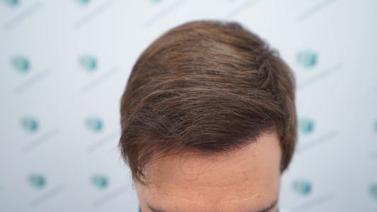 Injerto Capilar Técnica FUE Grafts 2365 (5983 Pelos) - REPARACIÓN 20 RESULTADOS INJERTO CAPILAR EN 12 MESES