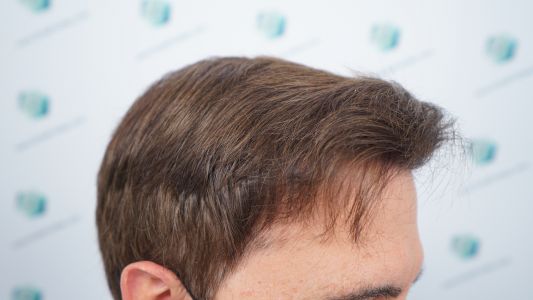 Injerto Capilar Técnica FUE Grafts 2365 (5983 Pelos) - REPARACIÓN 21 RESULTADOS INJERTO CAPILAR EN 12 MESES