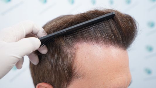 Injerto Capilar Técnica FUE Grafts 2365 (5983 Pelos) - REPARACIÓN 23 RESULTADOS INJERTO CAPILAR EN 12 MESES