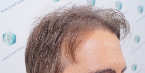 Injerto Capilar Técnica FUE Grafts 2365 (5983 Pelos) - REPARACIÓN 2 ANTES DE UN TRASPLANTE CAPILAR