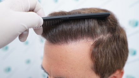 Injerto Capilar Técnica FUE Grafts 2365 (5983 Pelos) - REPARACIÓN 22 RESULTADOS INJERTO CAPILAR EN 12 MESES