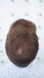 Injerto Capilar Técnica FUE Grafts 2365 (5983 Pelos) - REPARACIÓN 23 RESULTADOS INJERTO CAPILAR EN 12 MESES