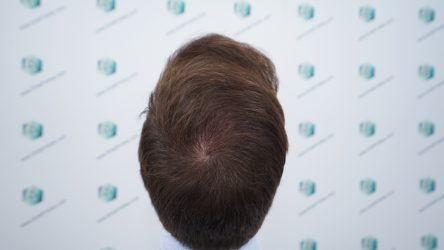 Injerto Capilar Técnica FUE Grafts 2365 (5983 Pelos) - REPARACIÓN 24 RESULTADOS INJERTO CAPILAR EN 12 MESES