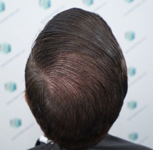 Injerto Capilar Técnica FUE Grafts 2365 (5983 Pelos) - REPARACIÓN 28 RESULTADOS INJERTO CAPILAR EN 12 MESES