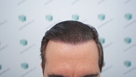 Injerto Capilar Técnica FUE Grafts 2365 (5983 Pelos) - REPARACIÓN 25 RESULTADOS INJERTO CAPILAR EN 12 MESES