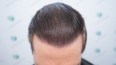 Injerto Capilar Técnica FUE Grafts 2365 (5983 Pelos) - REPARACIÓN 26 RESULTADOS INJERTO CAPILAR EN 12 MESES