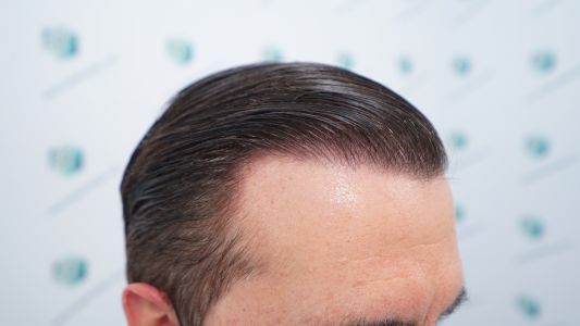 Injerto Capilar Técnica FUE Grafts 2365 (5983 Pelos) - REPARACIÓN 31 RESULTADOS INJERTO CAPILAR EN 12 MESES