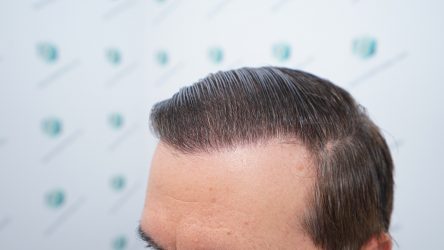 Injerto Capilar Técnica FUE Grafts 2365 (5983 Pelos) - REPARACIÓN 28 RESULTADOS INJERTO CAPILAR EN 12 MESES