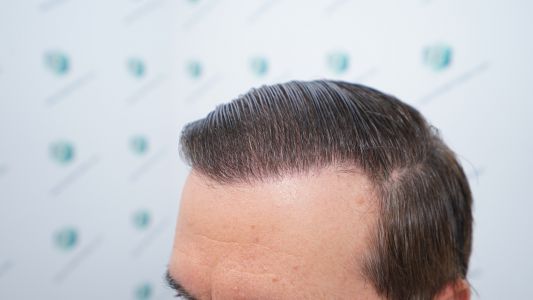 Injerto Capilar Técnica FUE Grafts 2365 (5983 Pelos) - REPARACIÓN 32 RESULTADOS INJERTO CAPILAR EN 12 MESES