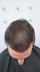 Injerto Capilar Técnica FUE Grafts 2365 (5983 Pelos) - REPARACIÓN 29 RESULTADOS INJERTO CAPILAR EN 12 MESES