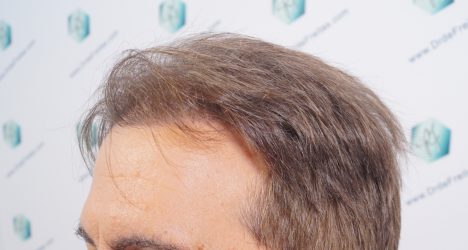 Injerto Capilar Técnica FUE Grafts 2365 (5983 Pelos) - REPARACIÓN 3 ANTES DE UN TRASPLANTE CAPILAR