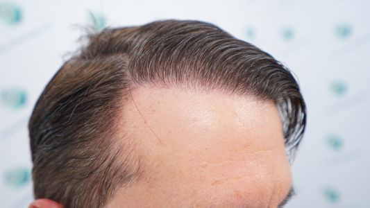 Injerto Capilar Técnica FUE Grafts 2365 (5983 Pelos) - REPARACIÓN 34 RESULTADOS INJERTO CAPILAR EN 12 MESES