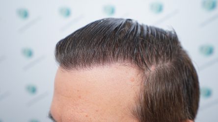 Injerto Capilar Técnica FUE Grafts 2365 (5983 Pelos) - REPARACIÓN 31 RESULTADOS INJERTO CAPILAR EN 12 MESES