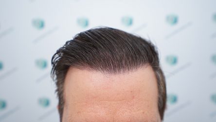 Injerto Capilar Técnica FUE Grafts 2365 (5983 Pelos) - REPARACIÓN 32 RESULTADOS INJERTO CAPILAR EN 12 MESES