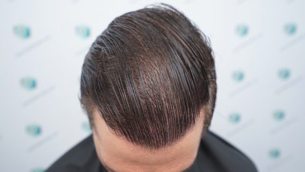 Injerto Capilar Técnica FUE Grafts 2365 (5983 Pelos) - REPARACIÓN 33 RESULTADOS INJERTO CAPILAR EN 12 MESES