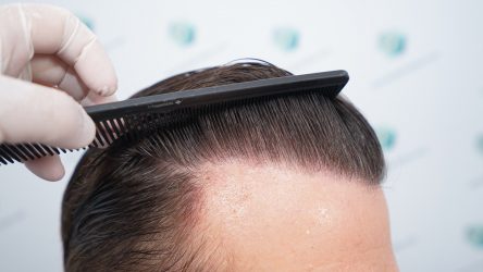 Injerto Capilar Técnica FUE Grafts 2365 (5983 Pelos) - REPARACIÓN 34 RESULTADOS INJERTO CAPILAR EN 12 MESES